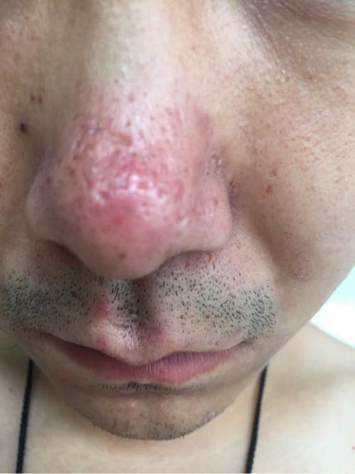 酒糟鼻什么症状