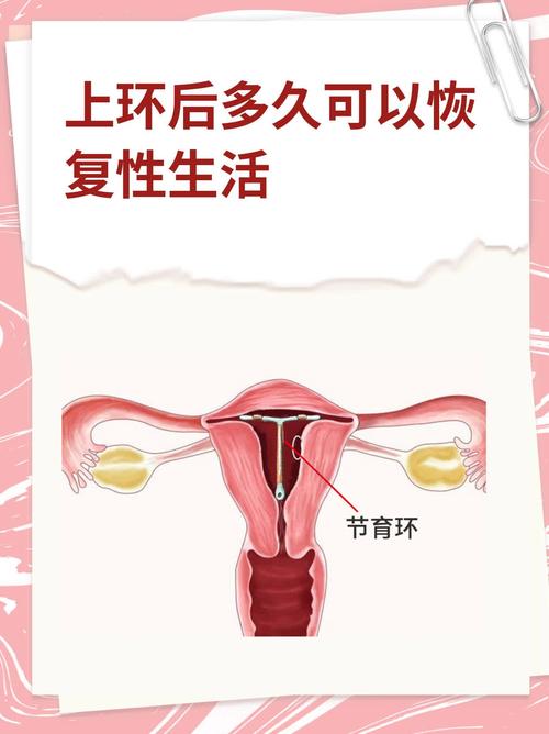 上环需要准备什么