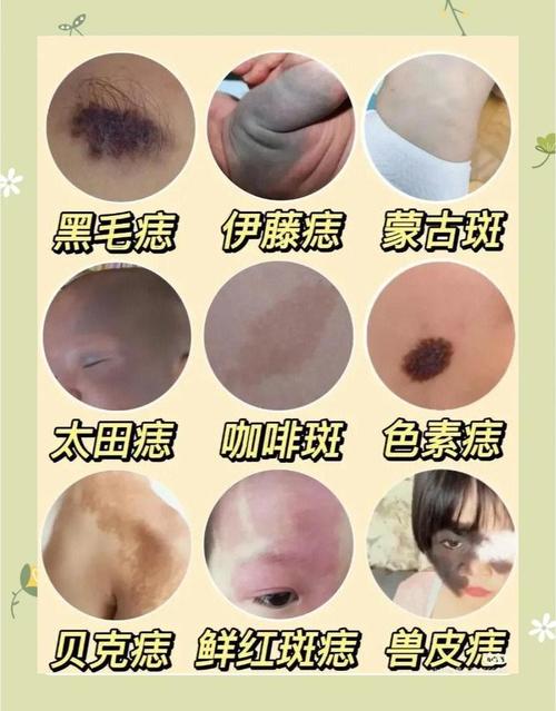 什么可以淡化胎记