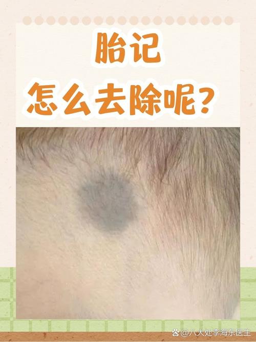 什么可以淡化胎记