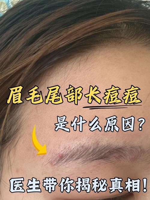 眉间长痘是什么原因