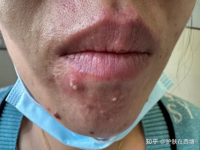 嘴边长痘痘什么原因