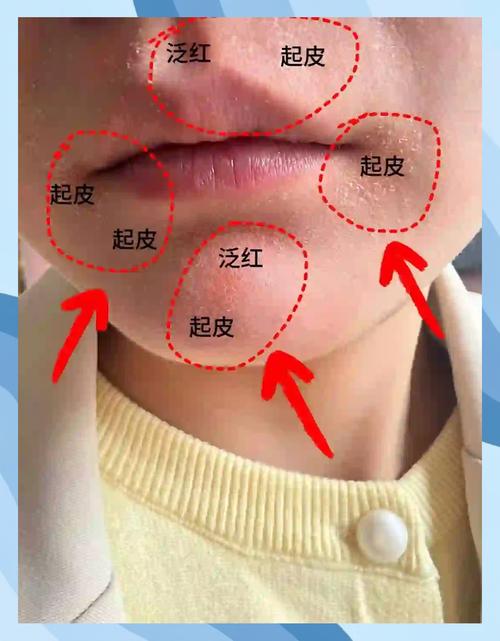 下巴起皮是什么原因