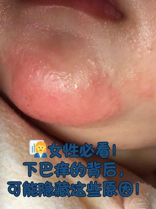 下巴起皮是什么原因