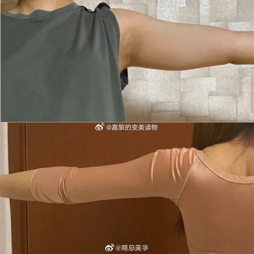 手臂吸脂减肥需要注意什么