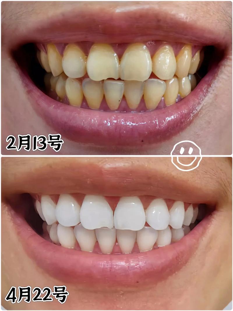 吃什么让牙齿变白