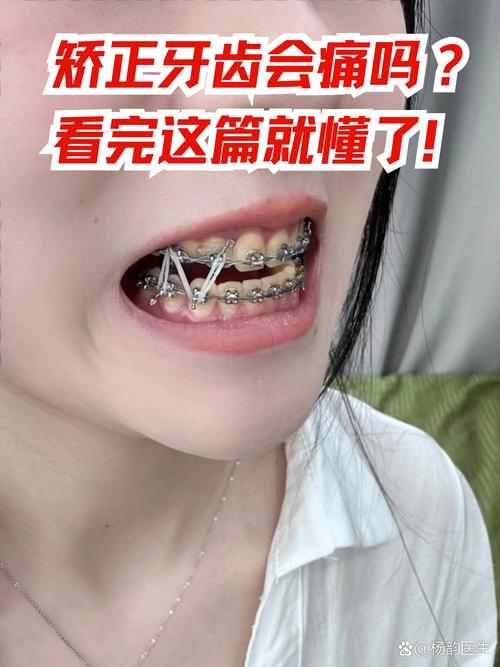 牙齿矫正有什么影响