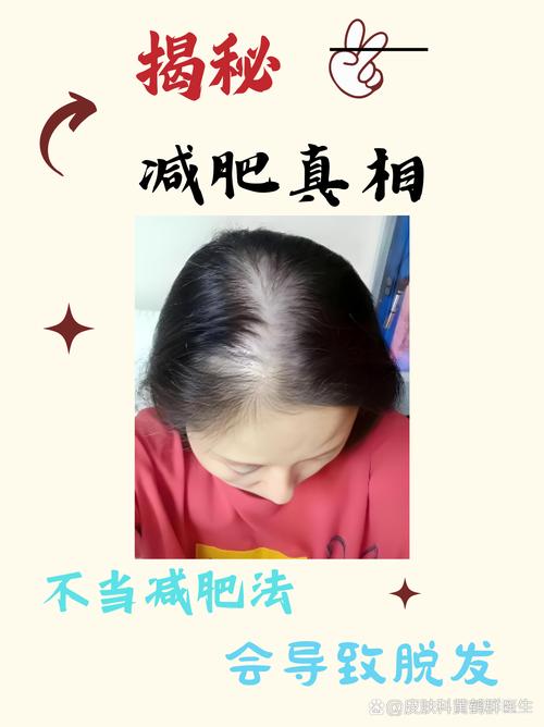 减肥掉头发严重是什么原因女性