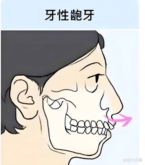 为什么会有龅牙
