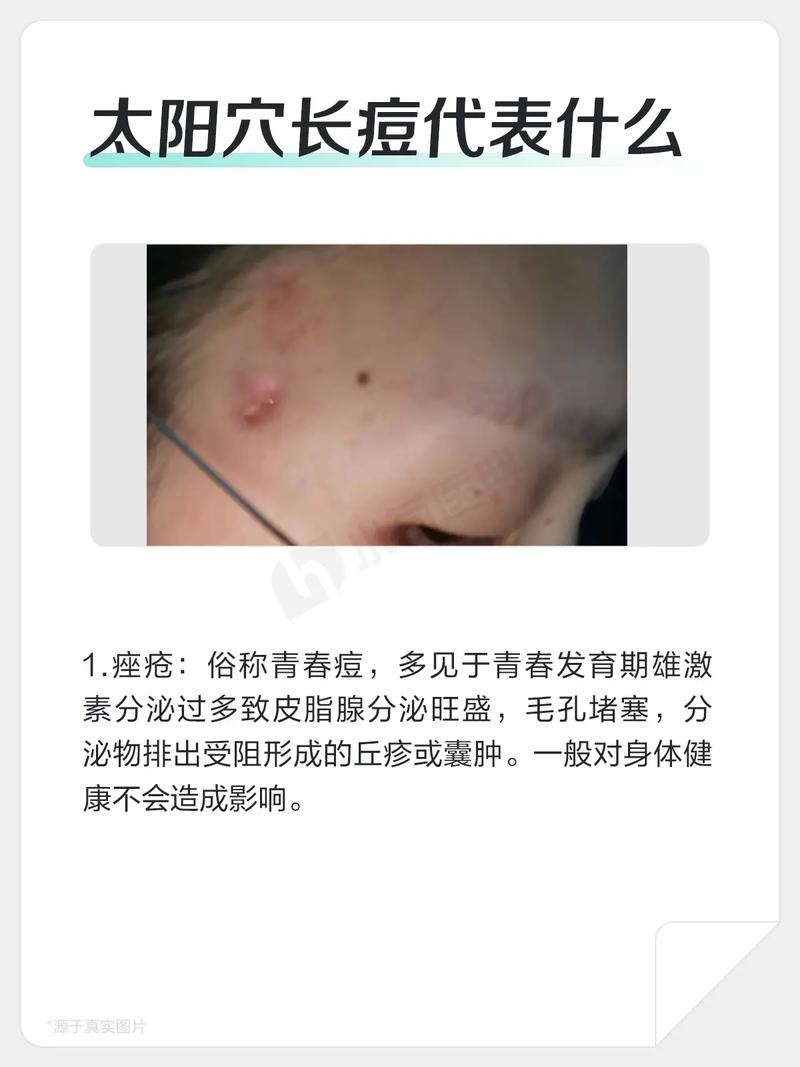 太阳穴长痘是什么