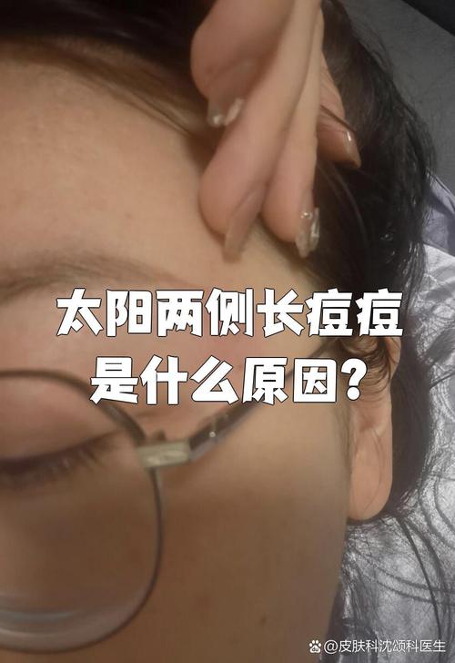 太阳穴长痘是什么