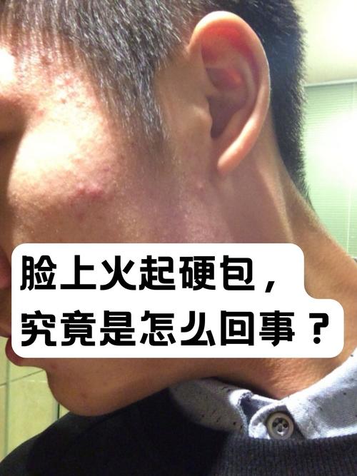 脸上上火是什么原因