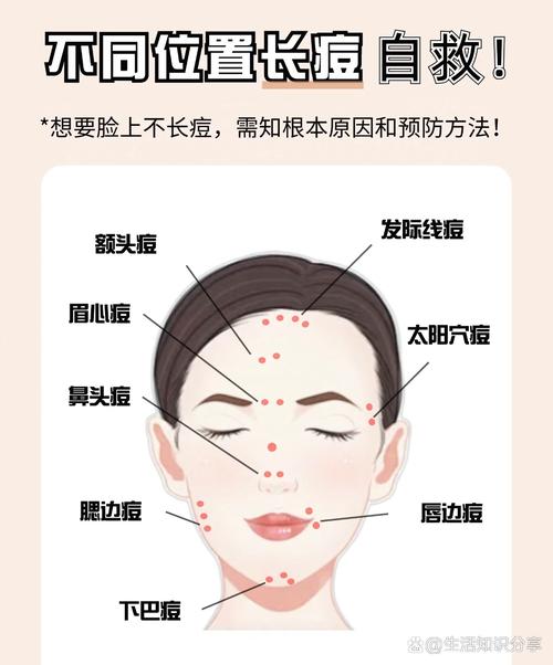 脸颊长痘因为什么