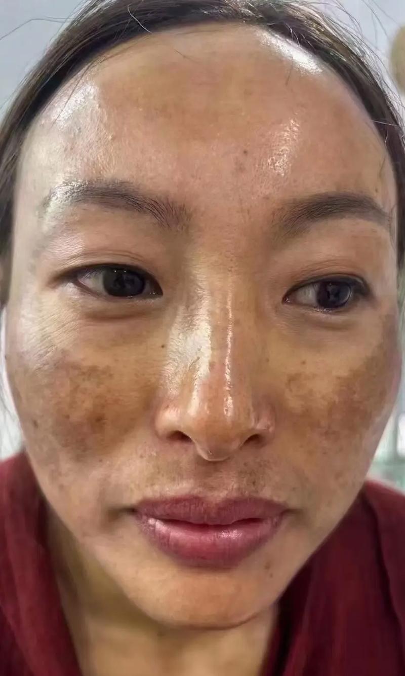 蝴蝶斑什么样