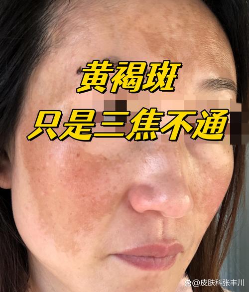 蝴蝶斑什么样