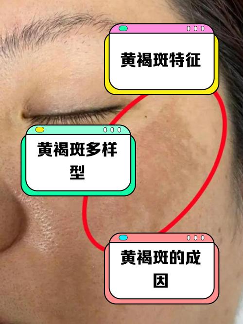 蝴蝶斑什么样