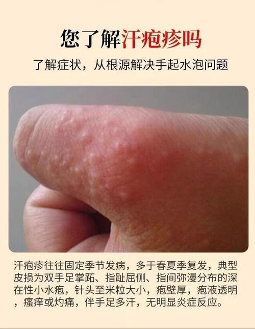 水泡型湿疹用什么药