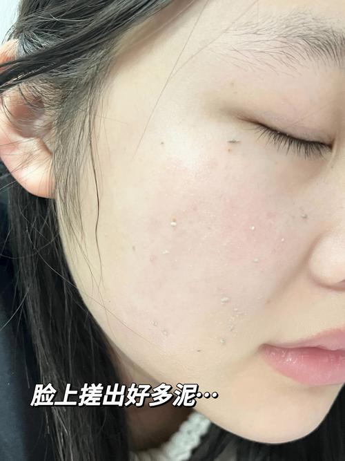 脸上角质是什么