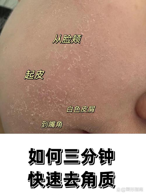 脸上角质是什么