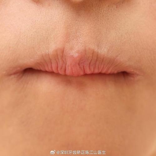 什么是咬唇