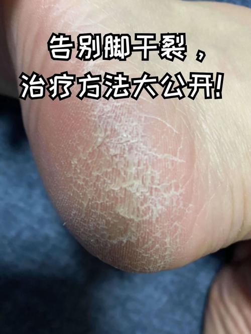 脚干为什么