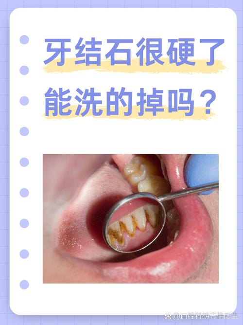 为什么会有牙石