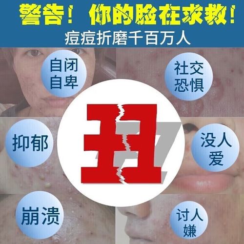 排毒祛痘吃什么药