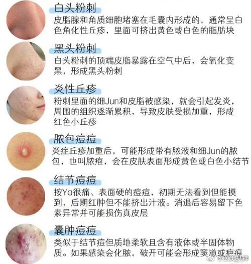 闷痘是什么意思
