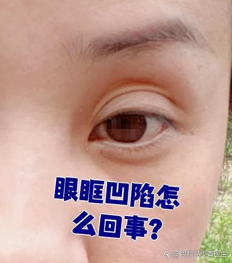 眼睛为什么会凹进去