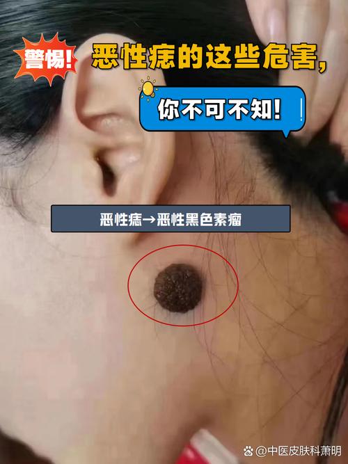 痣变黑是什么原因