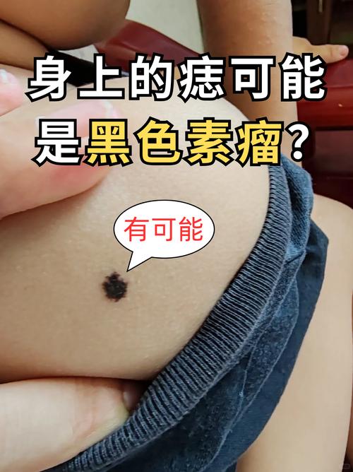 痣变黑是什么原因