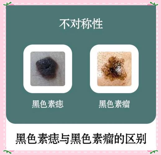 痣变黑是什么原因