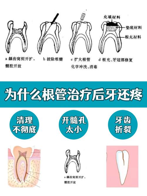 牙管是什么