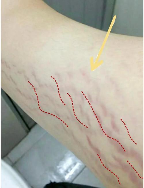 肥胖纹是什么样的