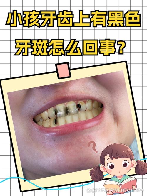 牙齿上黑黑的是什么