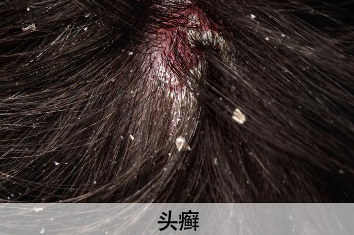 头癣是什么样的