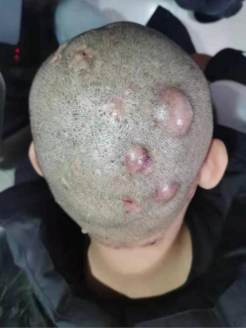什么是毛囊炎图片