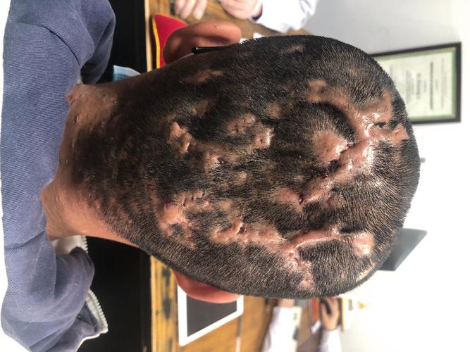什么是毛囊炎图片