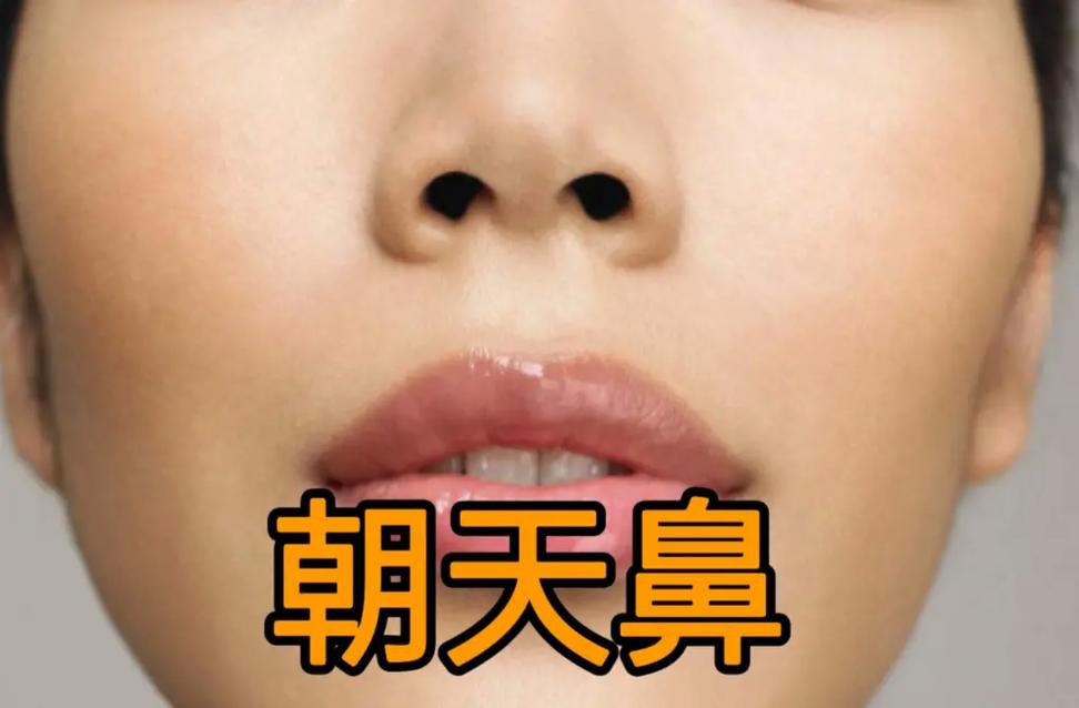 什么是朝天鼻