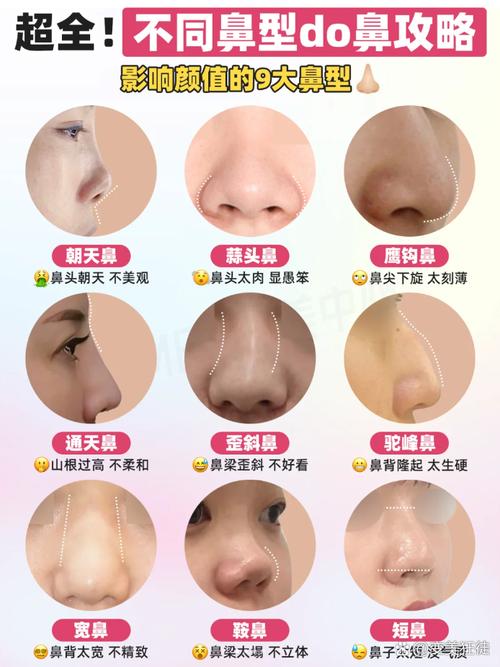 什么是朝天鼻