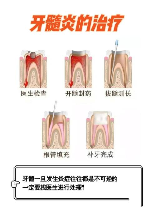 什么叫牙髓炎