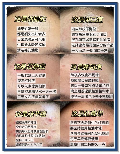 什么方法快速祛痘