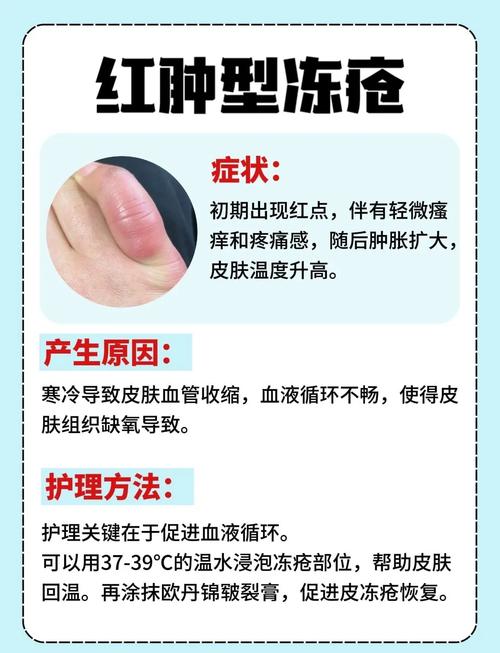 冻疮是什么引起的