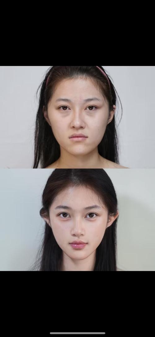 什么是微整容