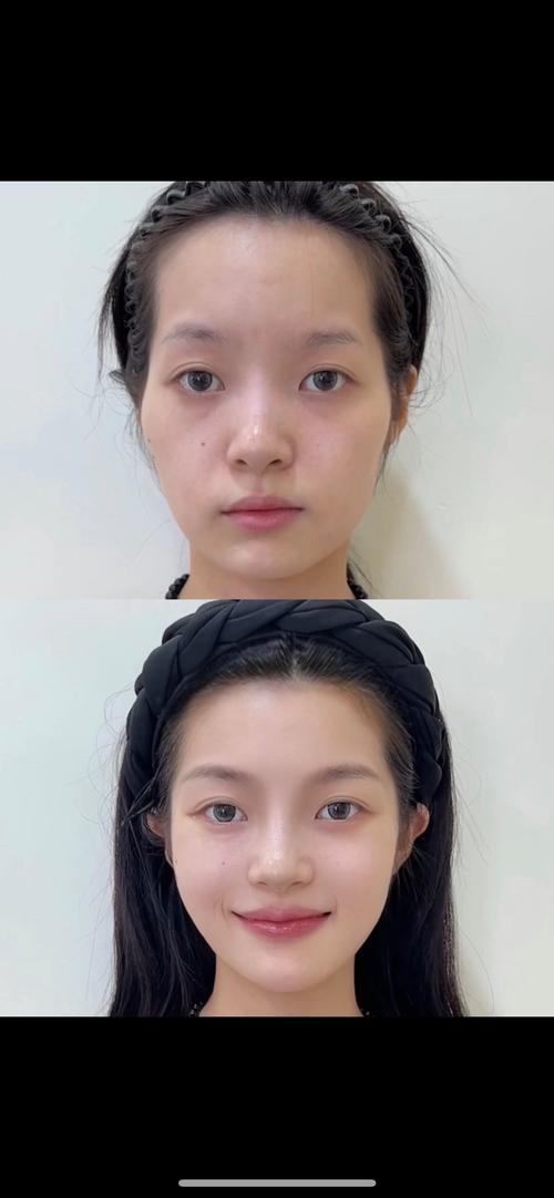 什么是微整容