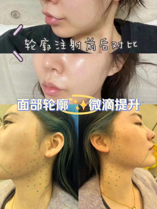 什么是面部提升