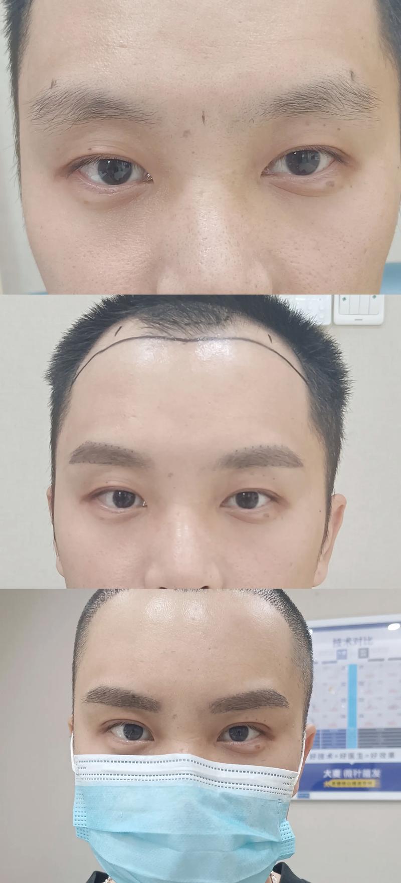 什么是植眉