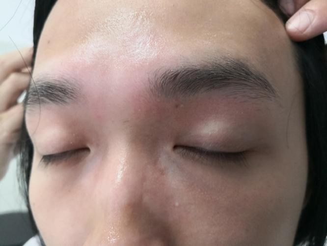 面部潮红是什么原因