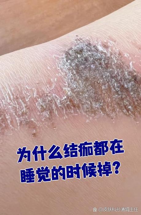 脱痂是什么意思