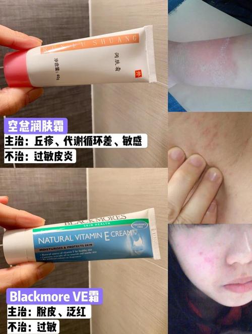面部过敏用什么药膏